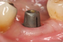 300_Implant During