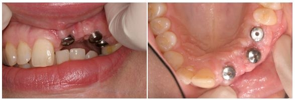 600_Implant During
