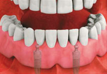 Implant Stabilized Denture 2