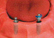 Implant Stabilized Denture